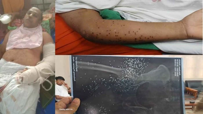 মৃত ভেবে ড্রেনের পাশে ফেলে রাখা হয়েছিল আমাকে” : জুলাই আন্দোলনে গুলিবিদ্ধ ইমনের বেঁচে ফেরার গল্প